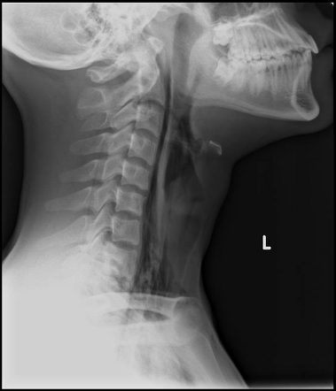 Esophageal perforation | Radiology Case | Radiopaedia.org