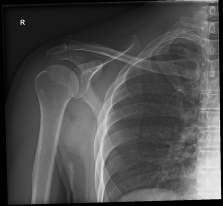 Normal Scapular Series Radiology Case Radiopaedia Org