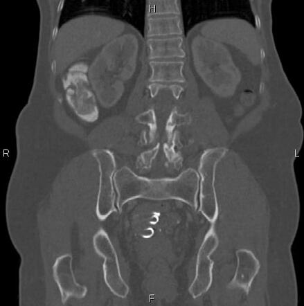 Lippes loop contraceptive device | Radiology Reference Article ...