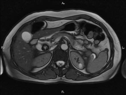 Mercedes-Benz sign (gallbladder) | Radiology Reference Article ...