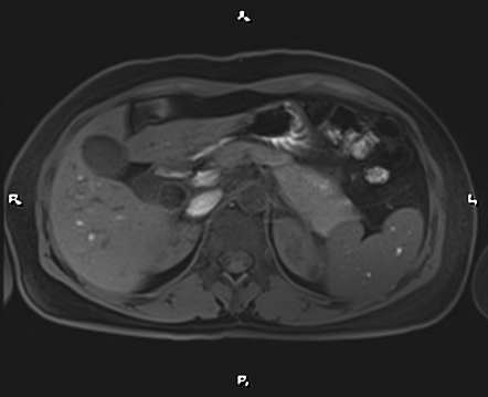 Mercedes-benz sign of gallstone - MRI | Image | Radiopaedia.org