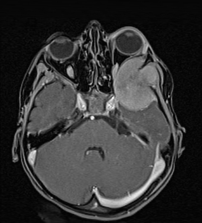 Neuroblastoma - Skull Metastasis | Image | Radiopaedia.org