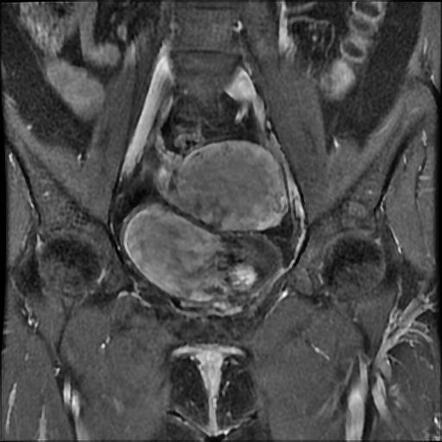 Bilateral ovarian dermoid cysts | Image | Radiopaedia.org