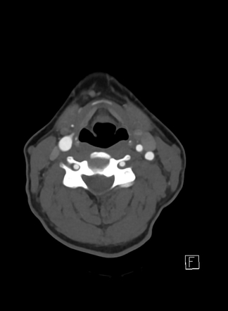 Fenestrated vertebral artery - right V2 segment | Radiology Case ...