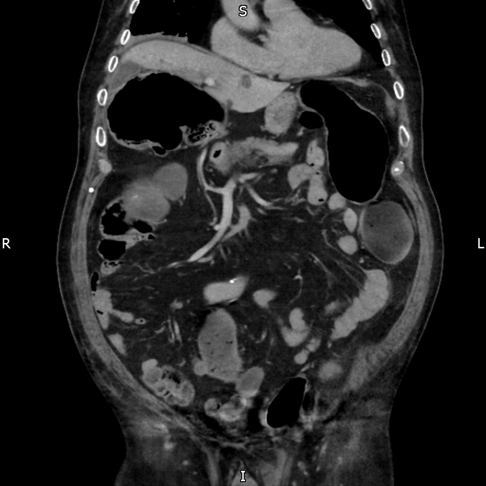 Ogilvie Syndrome Image