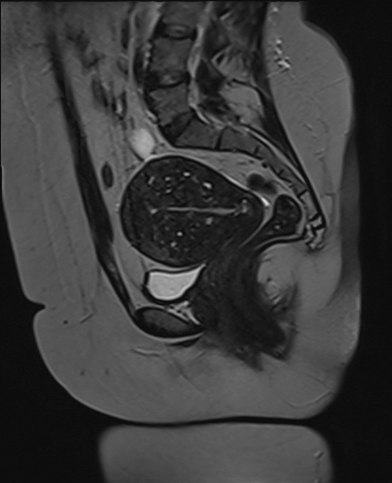 Diffuse uterine adenomyosis | Radiology Case | Radiopaedia.org