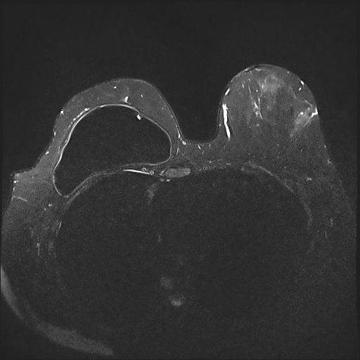 Breast Implant-associated Anaplastic Large-cell Lymphoma | Image ...