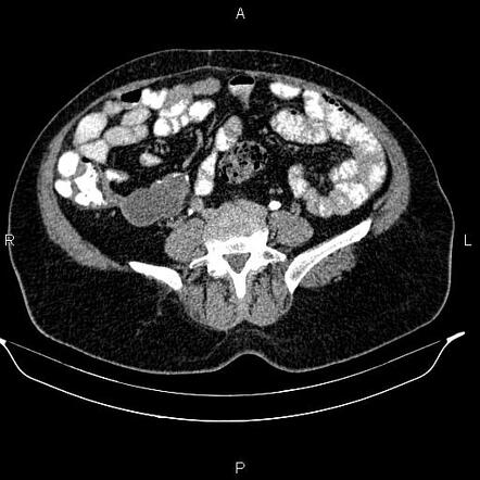 Appendiceal Mucocele | Radiology Case | Radiopaedia.org