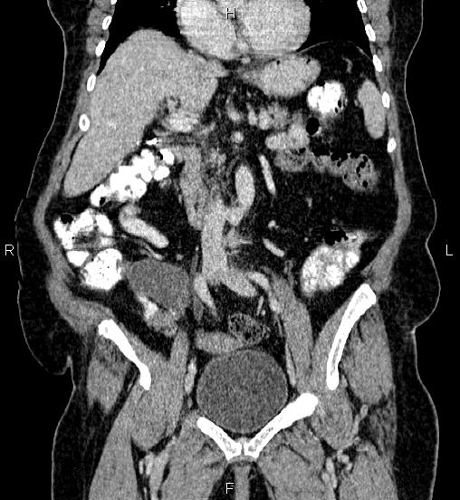 Appendiceal Mucocele Image