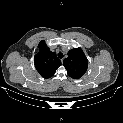 Pleural lipoma | Image | Radiopaedia.org