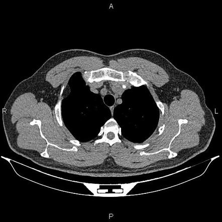 Pleural lipoma | Radiology Reference Article | Radiopaedia.org