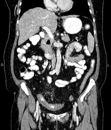 Crohn disease | Radiology Case | Radiopaedia.org