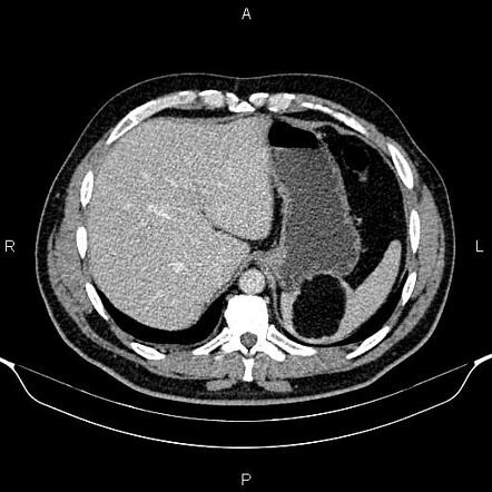 Fat-containing Splenic Lesions | Radiology Reference Article ...