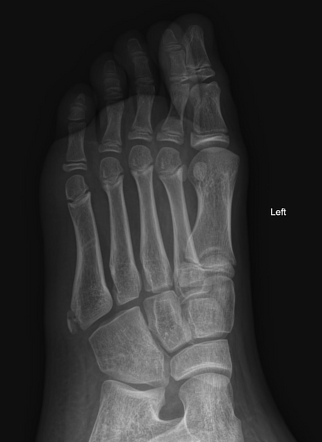 Iselin disease | Image | Radiopaedia.org