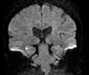 transient global amnesia emedicine