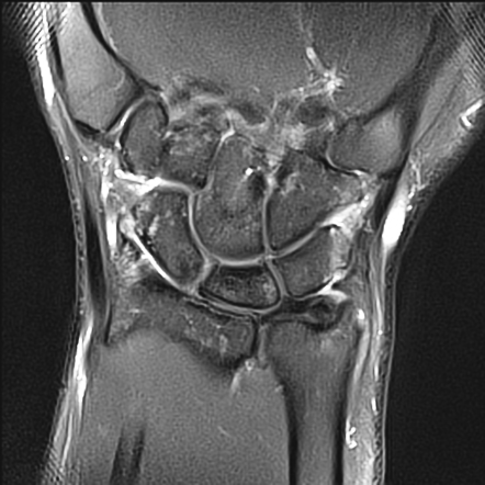 Kienbock disease | Image | Radiopaedia.org