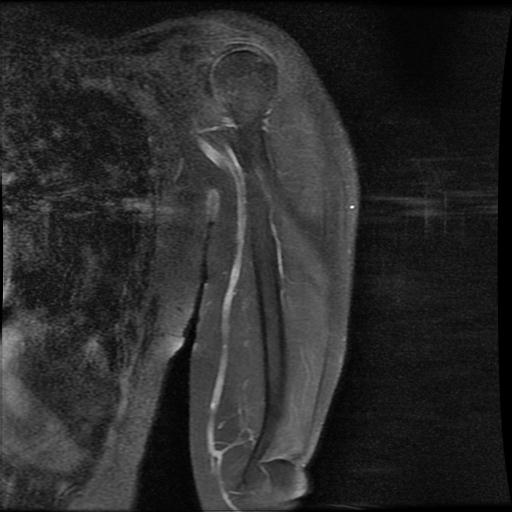 Undifferentiated pleomorphic sarcoma - arm | Image | Radiopaedia.org