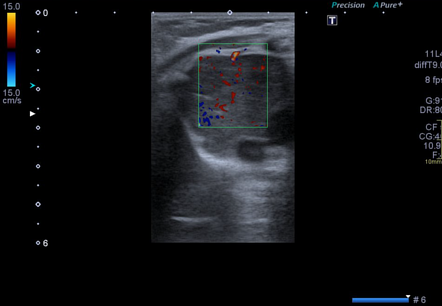 Normal thymus gland on ultrasound (infant) | Image | Radiopaedia.org