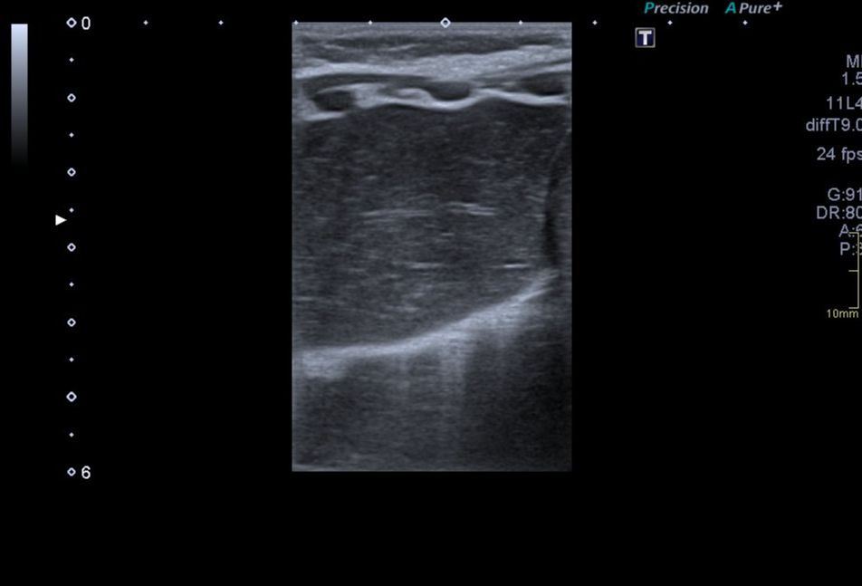 Normal thymus gland on ultrasound (infant) | Image | Radiopaedia.org