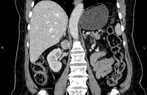 Retroperitoneal Paraganglioma Image 6502