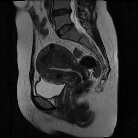 Diffuse uterine adenomyosis | Radiology Case | Radiopaedia.org