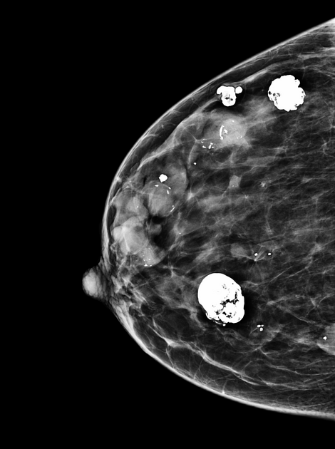 Fibroadenoma breast Radiology Reference Article Radiopaedia