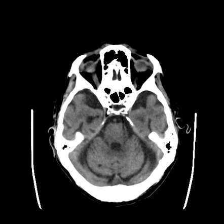 Effect of low hematocrit on dural venous sinus density on noncontrast ...