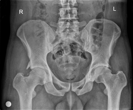 Rectus femoris origin tendon ossification | Image | Radiopaedia.org