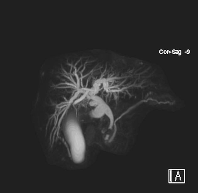 Choledocholithiasis Radiology Reference Article