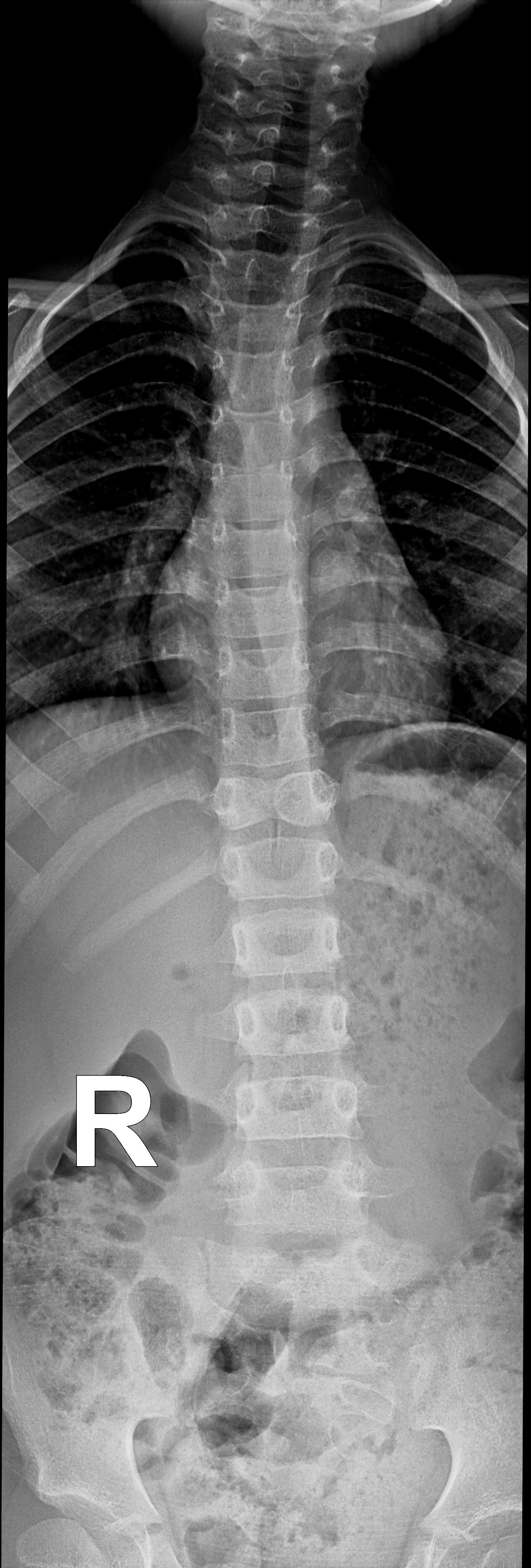 Butterfly vertebrae | Image | Radiopaedia.org