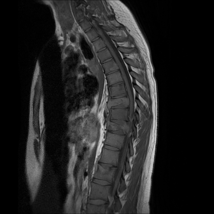 Tuberculous Spondylodiscitis | Radiology Case | Radiopaedia.org