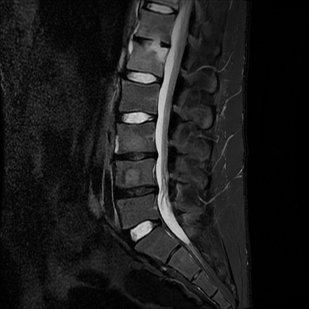 Tuberculous Spondylodiscitis | Image | Radiopaedia.org