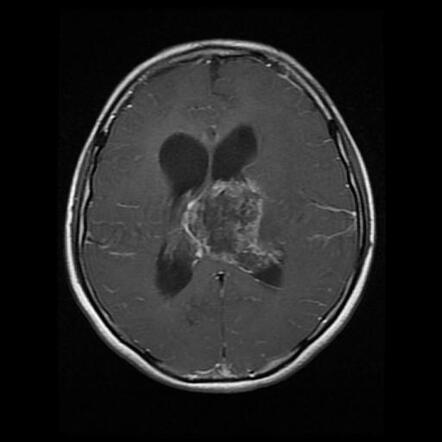 Diffuse Midline Glioma - H3 K27m–mutant 