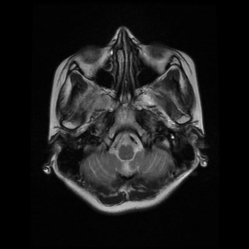 Diffuse Midline Glioma - H3 K27m–mutant 