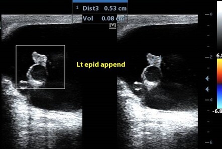 Scrotal Hydroceles | Image | Radiopaedia.org