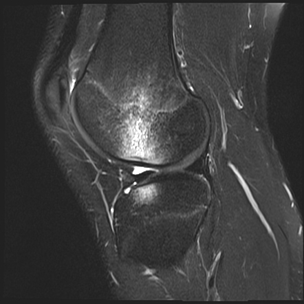 Subchondral femoral condyle fractures - hyperextension injury ...