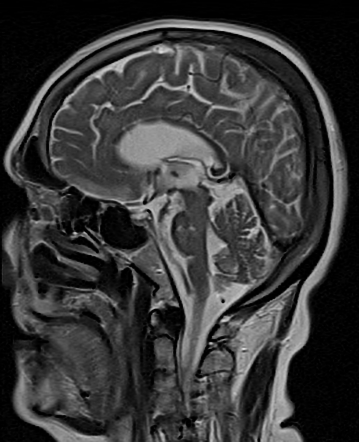 Leukoaraiosis | Image | Radiopaedia.org