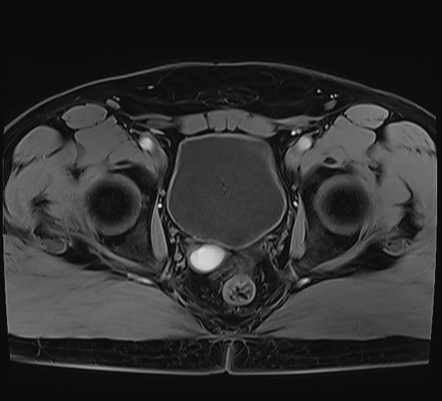 Seminal Vesicle Agenesis Radiology Reference Article Radiopaedia Org