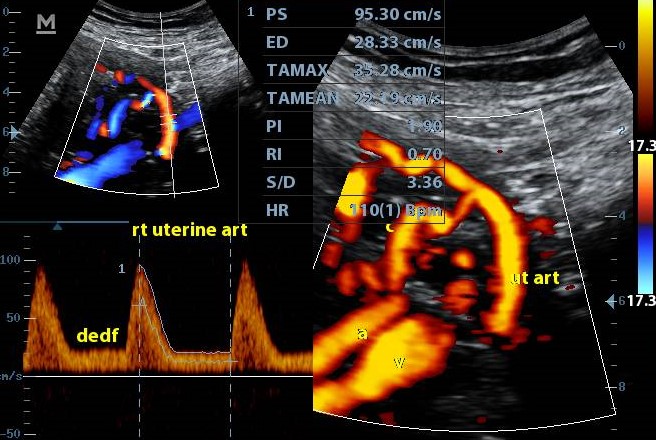 Uterine Arteries Arterial Collaterals Image