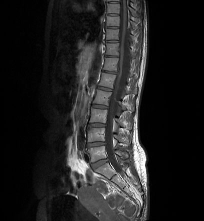 Extradural spinal arachnoid cyst | Image | Radiopaedia.org