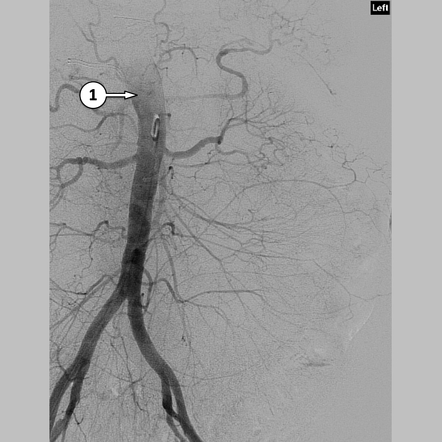 Normal abdominal aortic angiogram (DSA) | Radiology Case | Radiopaedia.org