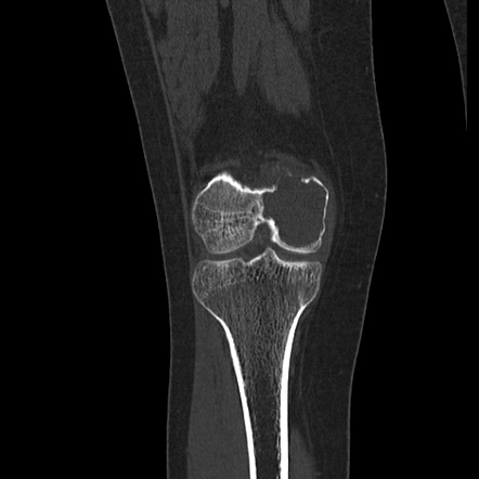 Giant cell tumor | Image | Radiopaedia.org