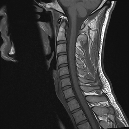 Cervical foraminal stenosis - mild | Image | Radiopaedia.org