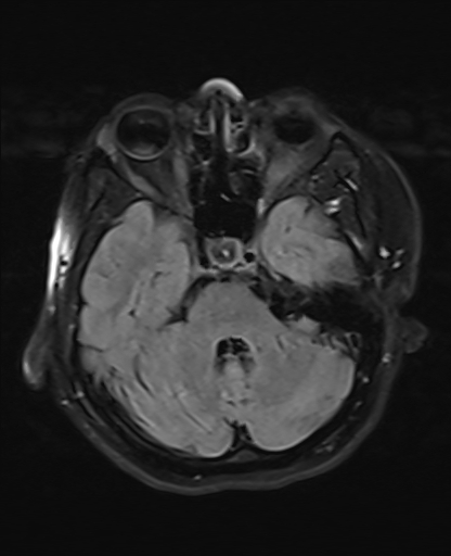 Polymicrogyria | Image | Radiopaedia.org