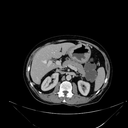 Gastric adenocarcinoma | Image | Radiopaedia.org