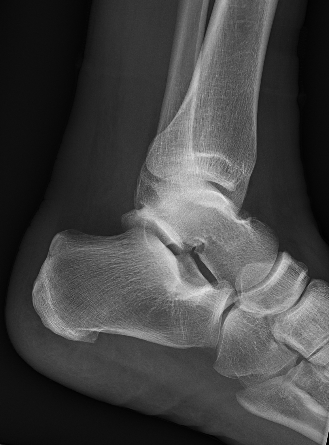 Distal fibular stress fracture | Image | Radiopaedia.org