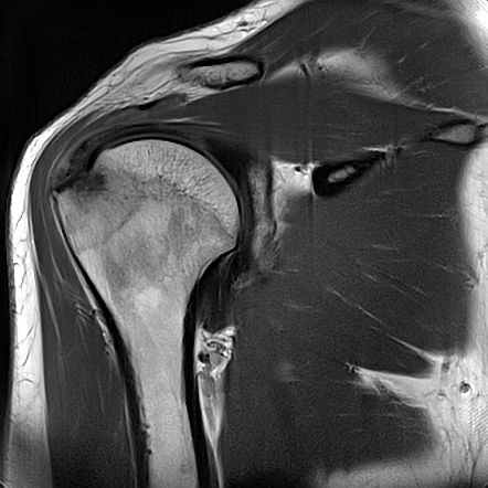 Supraspinatus Calcific Tendinitis With Intraosseous Extension Image