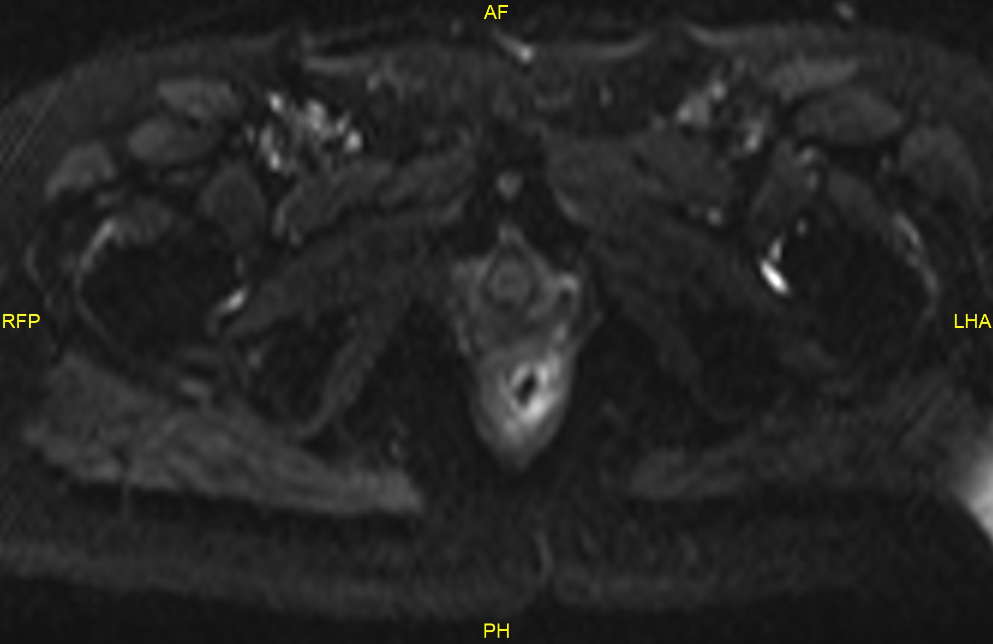 Thrombosed internal hemorrhoids Image