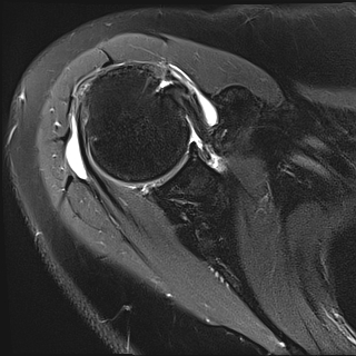 Subacromial impingement | Image | Radiopaedia.org