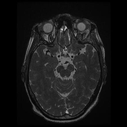 Developmental venous anomaly - pons | Image | Radiopaedia.org